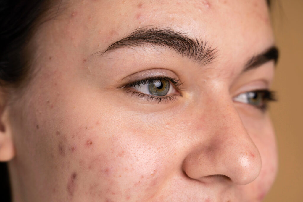 Acne treatment Vancouver